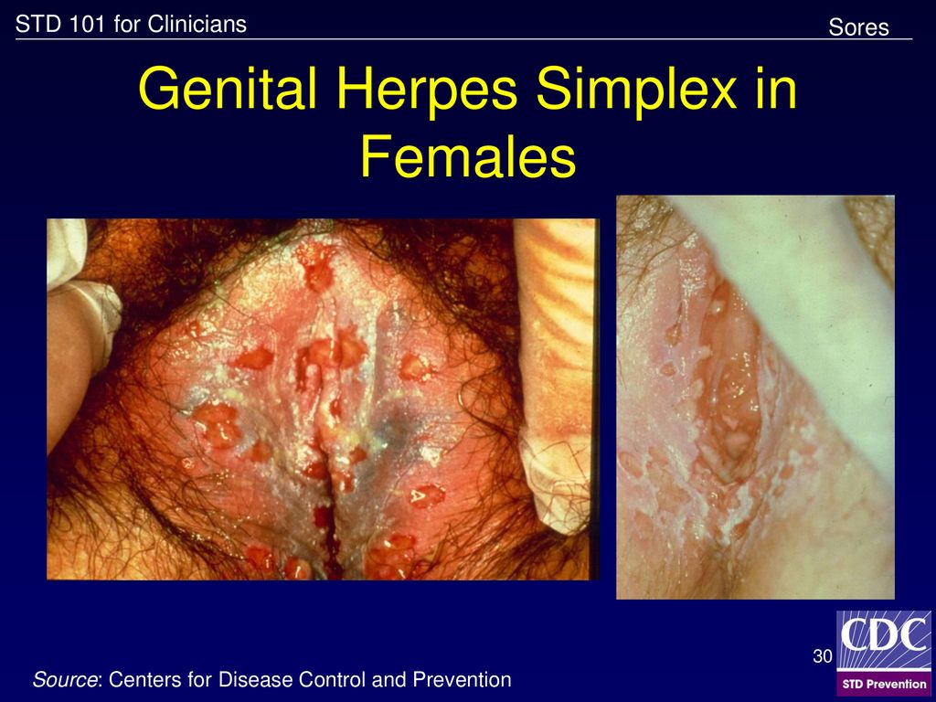 Genital Herpes Simplex in Females.