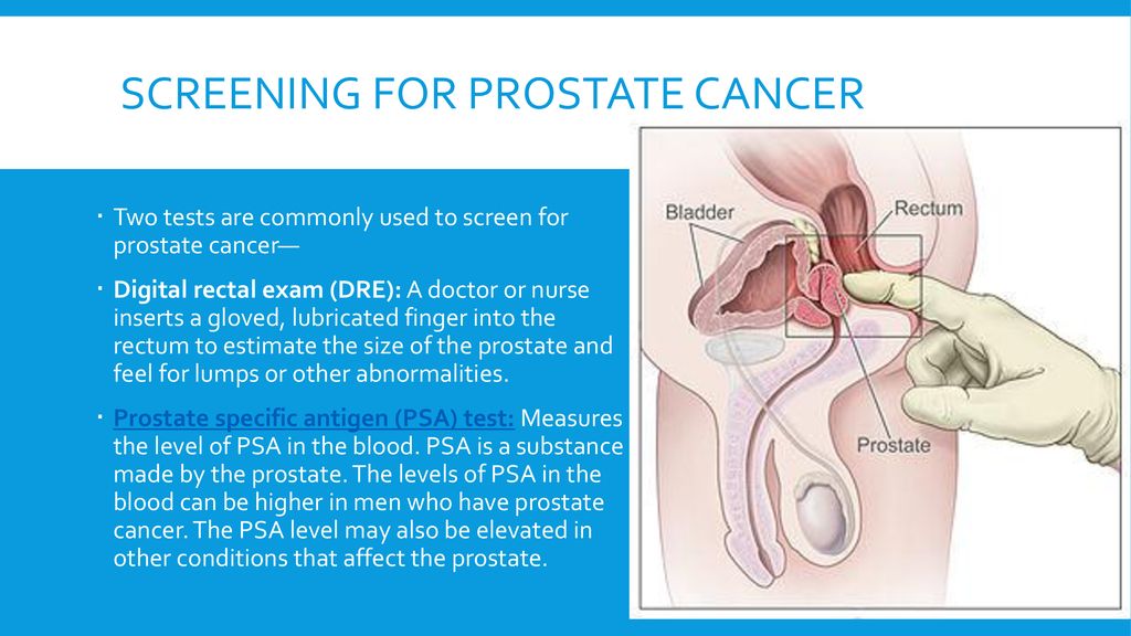 Screening for prostate cancer.