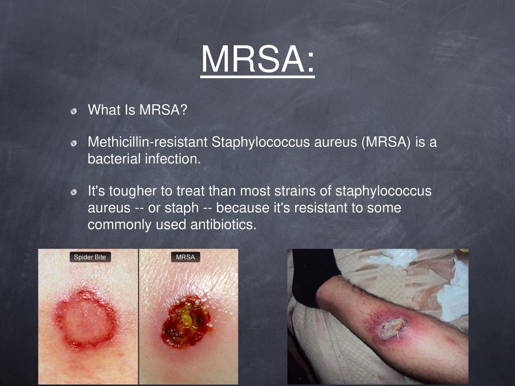 Infections ppt download