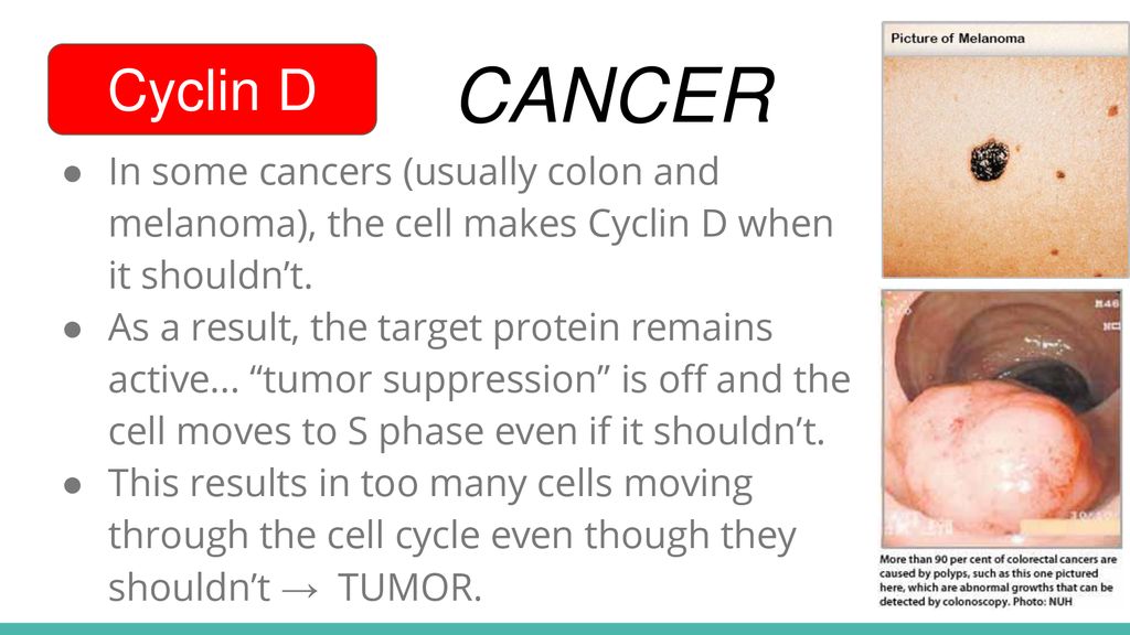 Cyclin D CANCER. In some cancers (usually colon and melanoma), the cell makes Cyclin D when it shouldn’t.