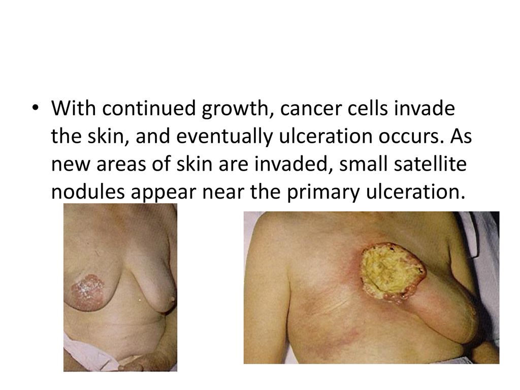 Anatomy The Breast Is Composed Of 15 20 Lobes Which Are Each Composed Of Several Lobules Each Lobe Of The Breast Terminates In A Major Lactiferous Ppt Download