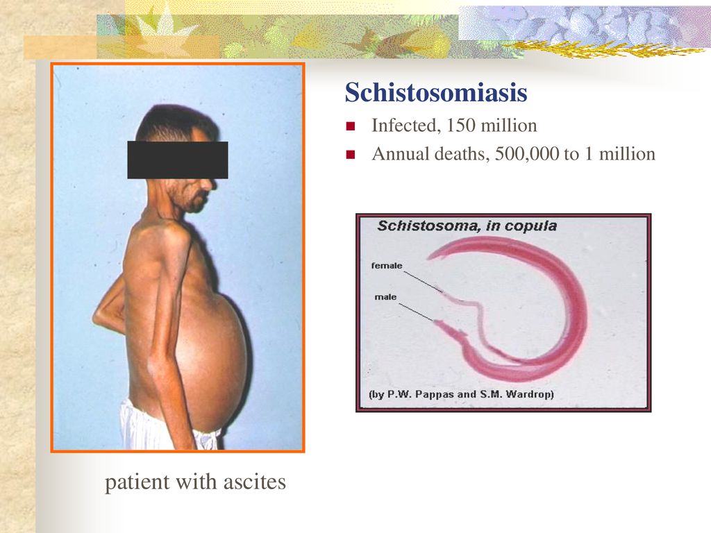 schistosomiasis patient