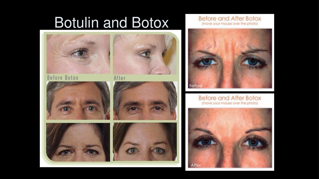Botulin and Botox