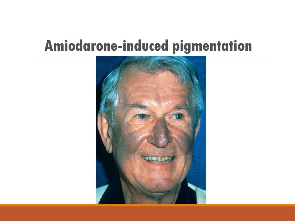 Skin Discoloration from Amiodarone