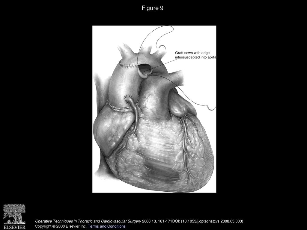 Aortic Root Replacement with a Composite Valved Conduit - ppt download