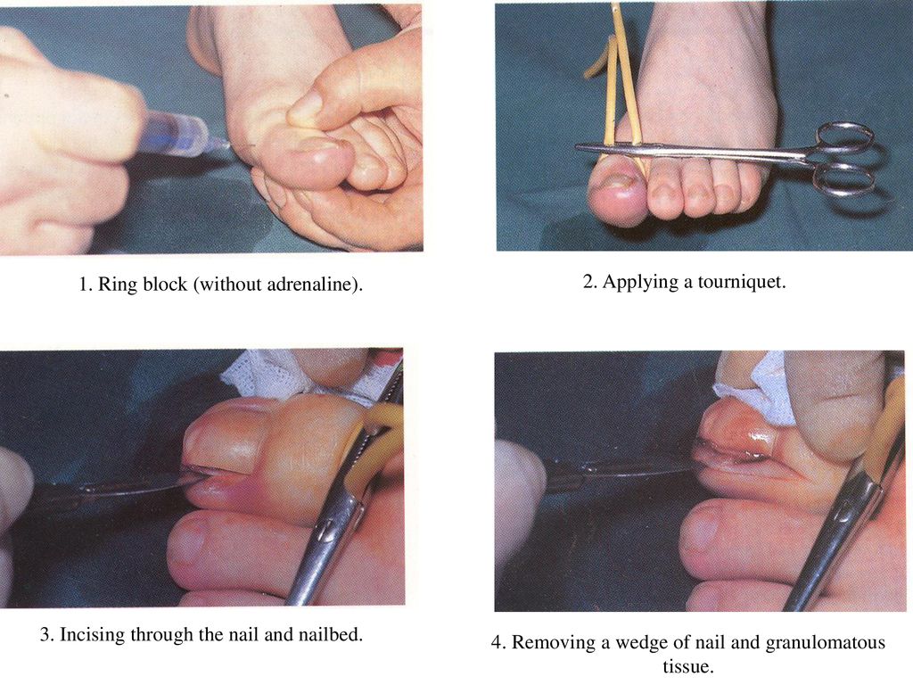 Exploring a Minimally Invasive Technique for Surgical Nail Matrixectomy |  Podiatry Today
