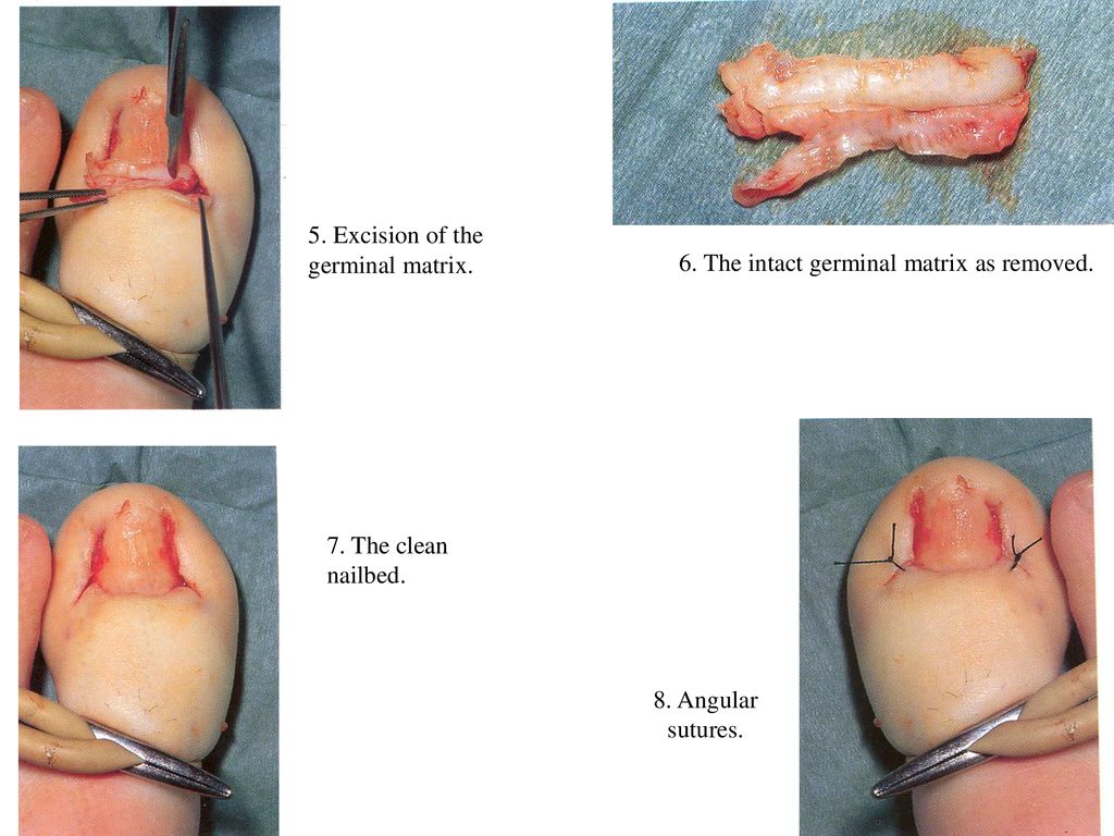 Anyone ever gotten a nail avulsion under general anaesthesia? :  r/Ingrown_Toenails