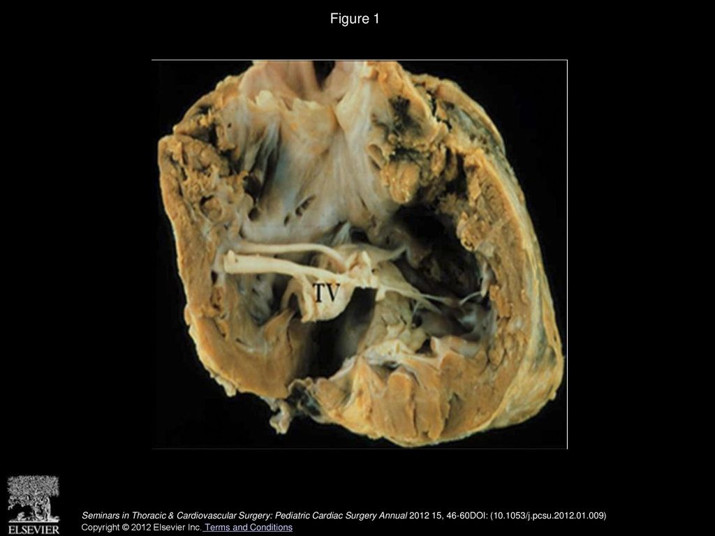 Figure 1 Pathologic specimens showing tricuspid valve with dysplastic leaflets but no displacement. TV, tricuspid valve.