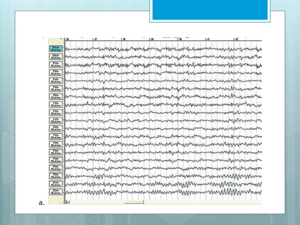 brain function. An EEG record is shown in 2.11a