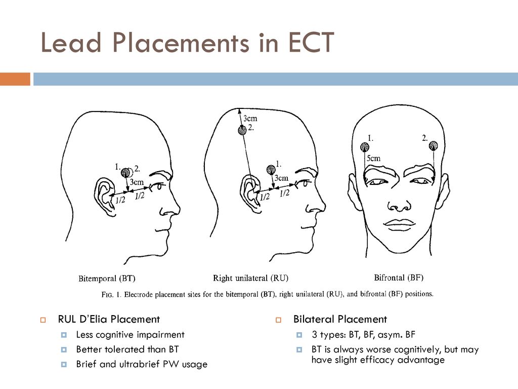 An Overview of Electroconvulsive Therapy - ppt download