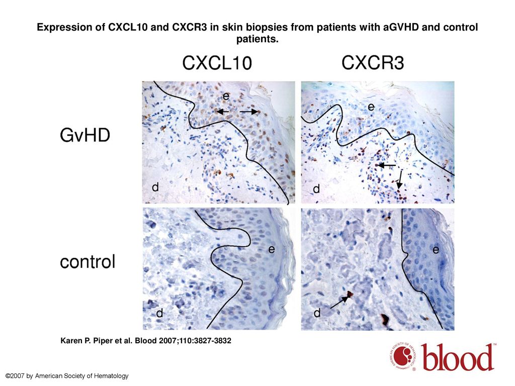 Expression of CXCL10 and CXCR3 in skin biopsies from patients with aGVHD and control patients.