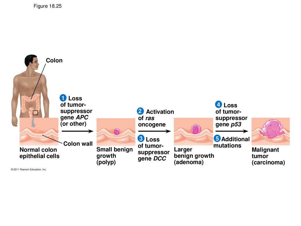 Loss of tumor- suppressor gene APC (or other) 4
