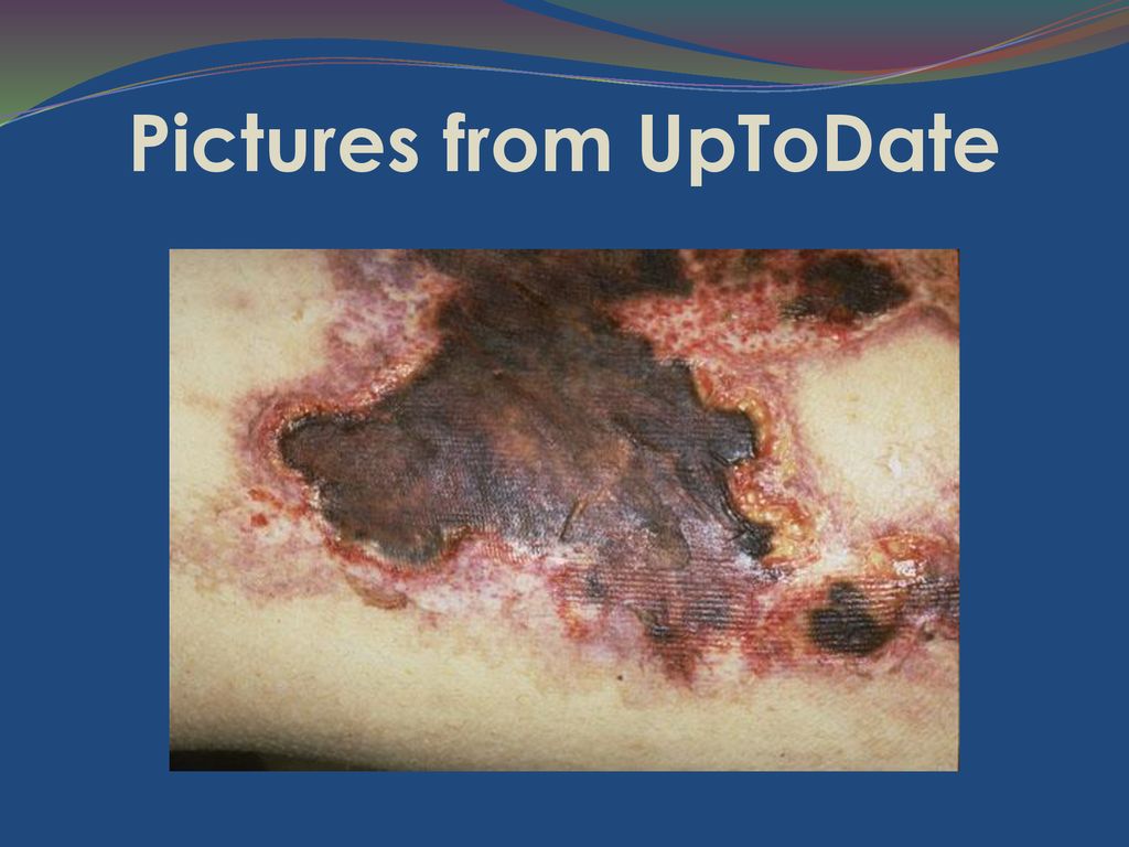 calciphylaxis treatment uptodate