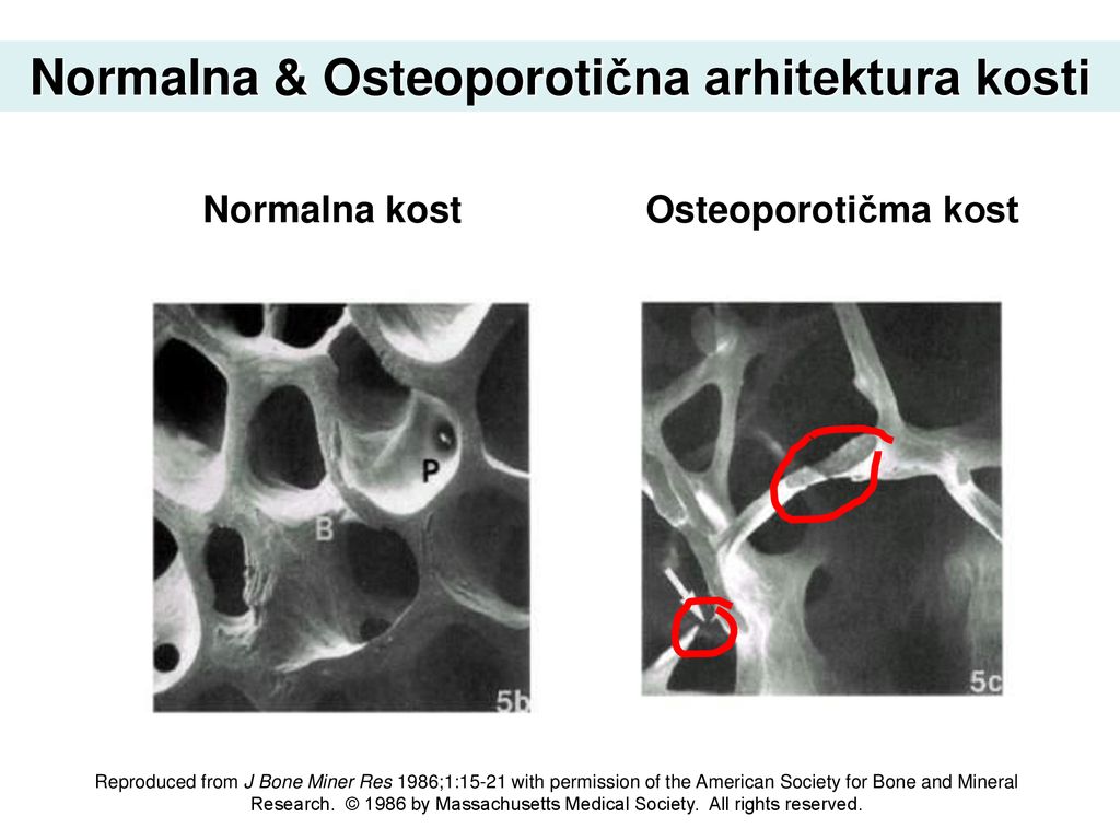 osteoporoza kuka ublažava bol