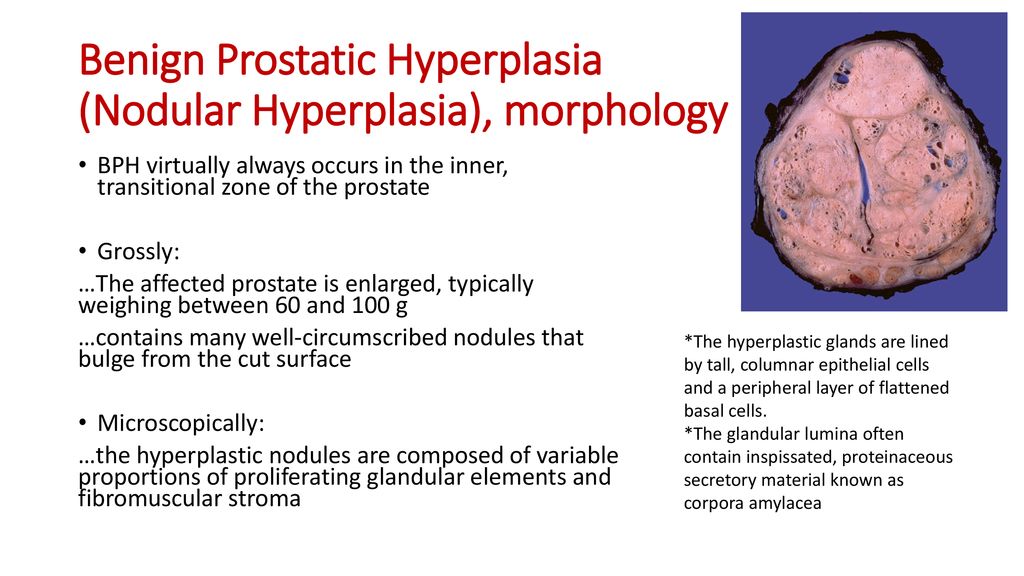 Some prostatic diseases - ppt download