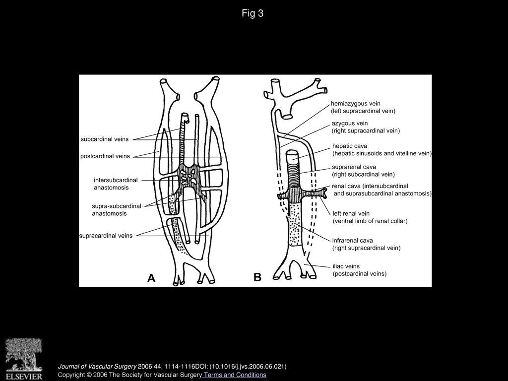 Fig 3 Embryologic derivation of the inferior vena cava from 7 weeks of gestation (A) to the adult (B).