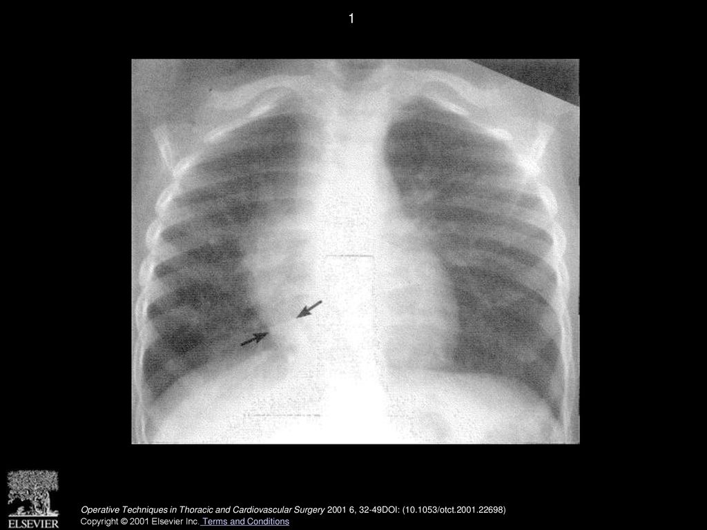 1 Chest radiograph illustrating the appearance and course of the anomalous right pulmonary, or scimitar, vein (arrow).