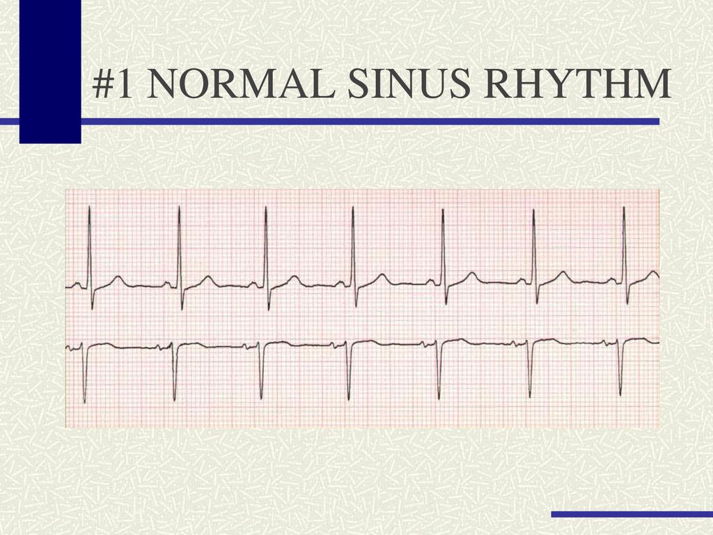 RHYTHM STRIP INTERPRETATION - ppt download