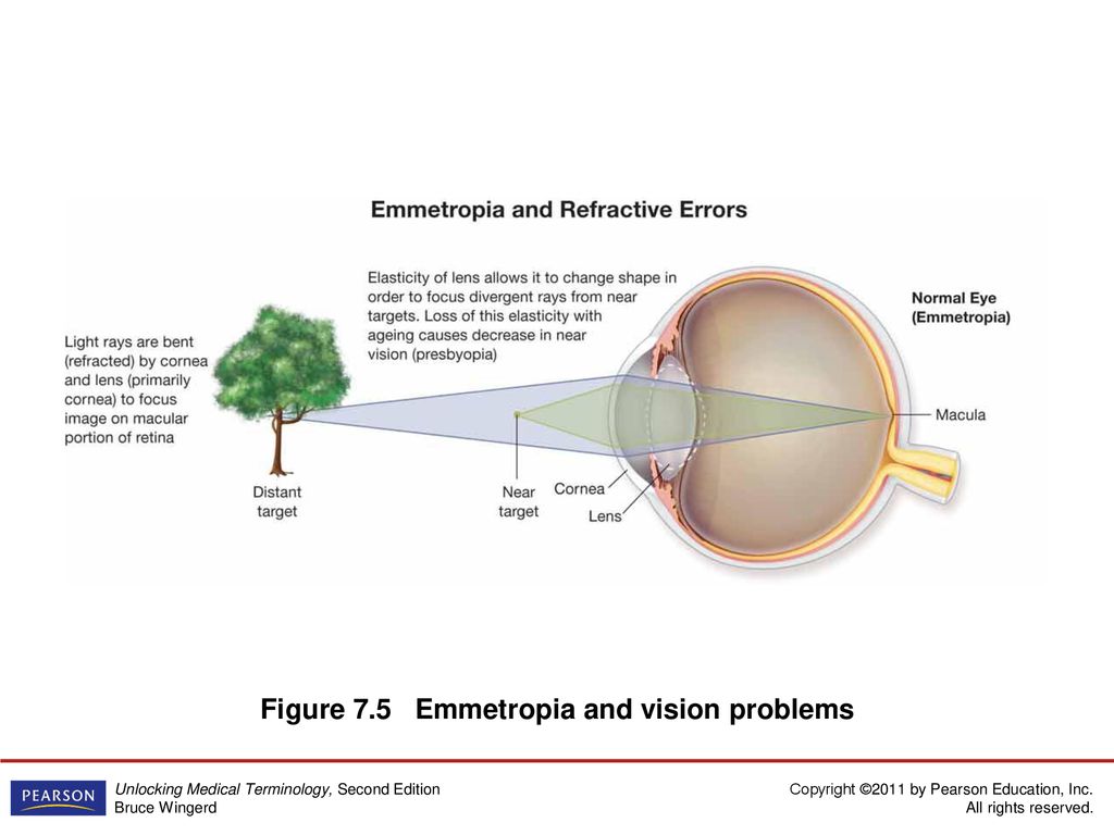 Figure 7.5 Emmetropia and vision problems