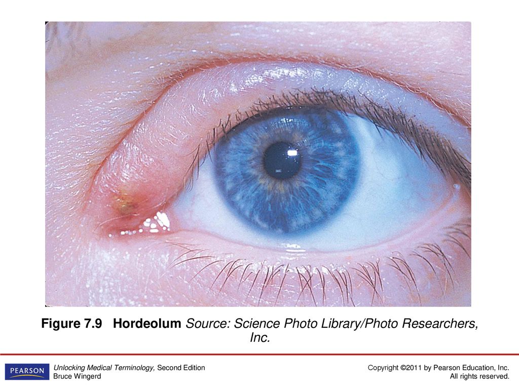 Figure 7.9 Hordeolum Source: Science Photo Library/Photo Researchers, Inc.