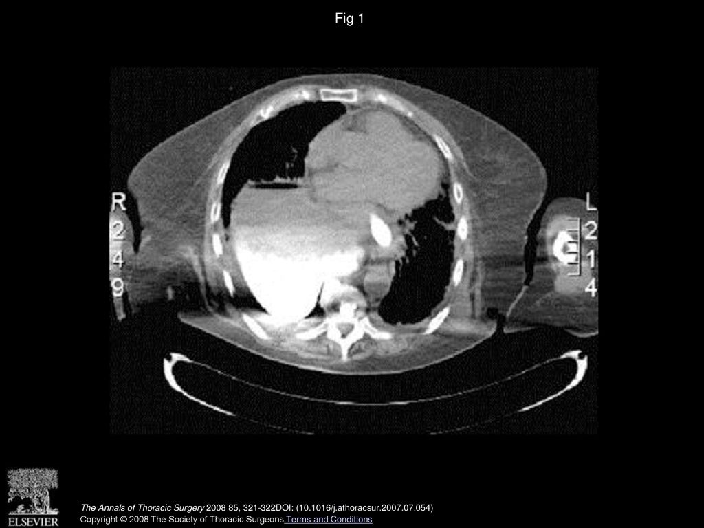 Fig 1 Computed tomography scan of the thorax after a motor vehicle accident shows an intrathoracic stomach on the right side.