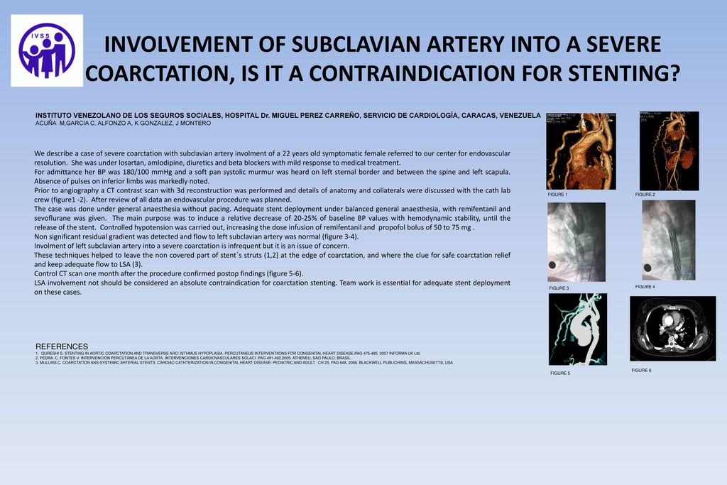 InvolVEment of subclavian artery into a severe coarctation is it a