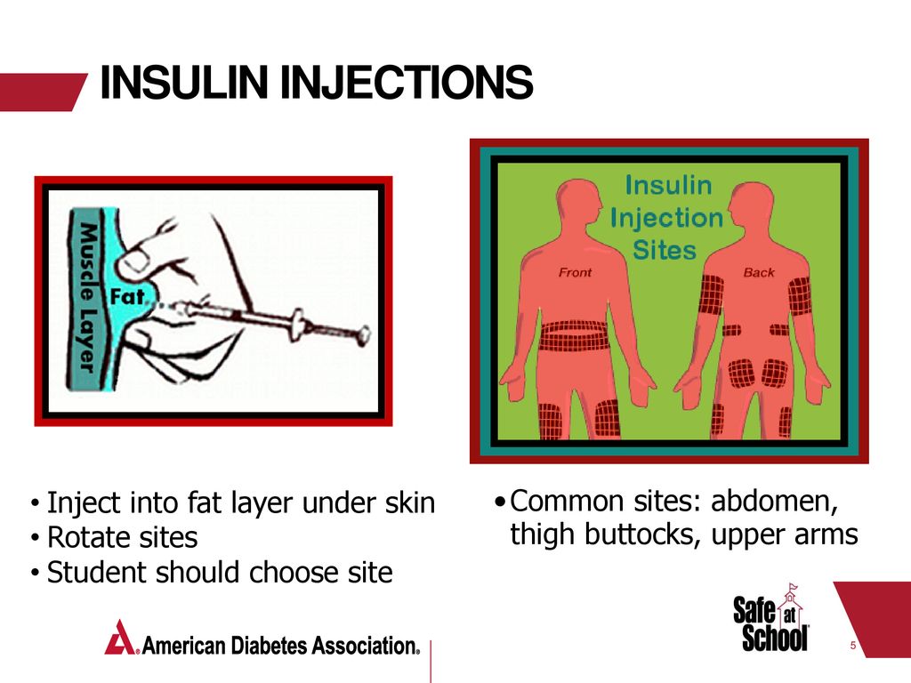 Diabetes care tasks at school what key personnel need to know ppt