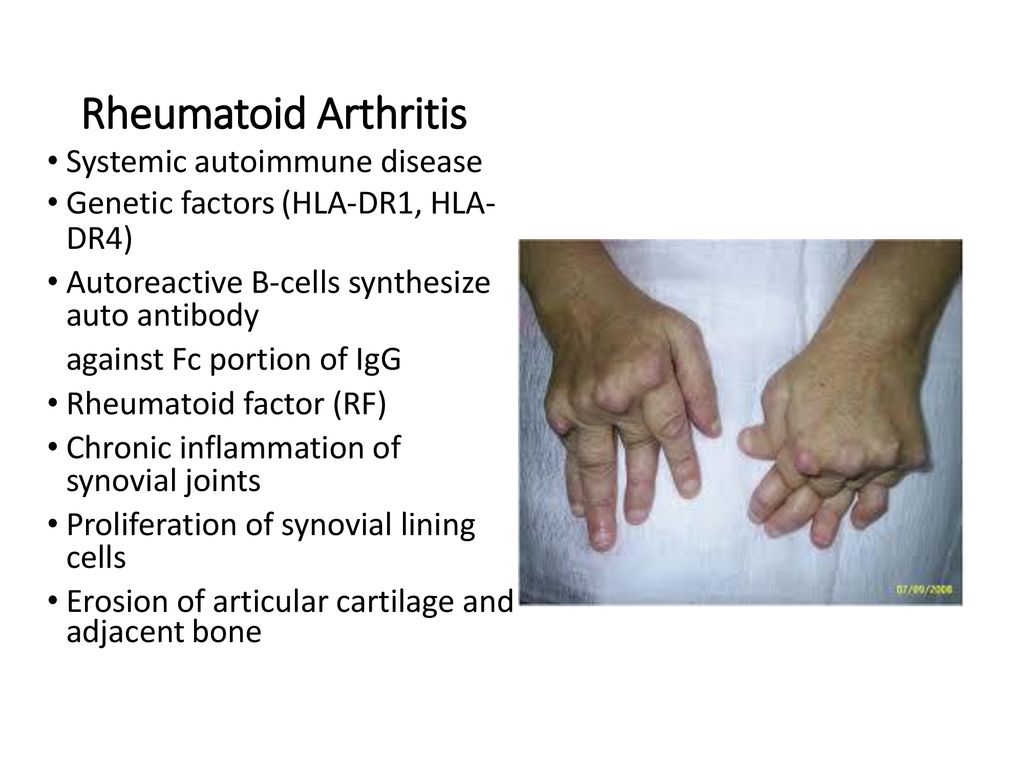 systemic autoimmune disease rheumatoid arthritis