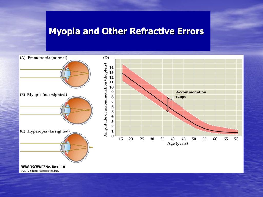 Myopia and Other Refractive Errors