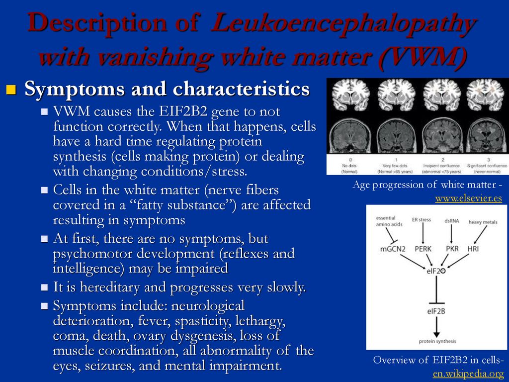 Description of Leukoencephalopathy with vanishing white matter (VWM)