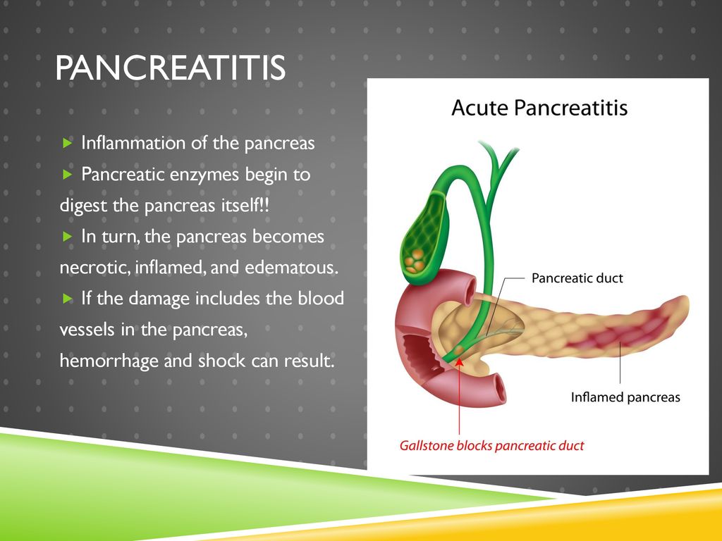 Pancreatitis Inflammation of the pancreas Pancreatic enzymes begin to