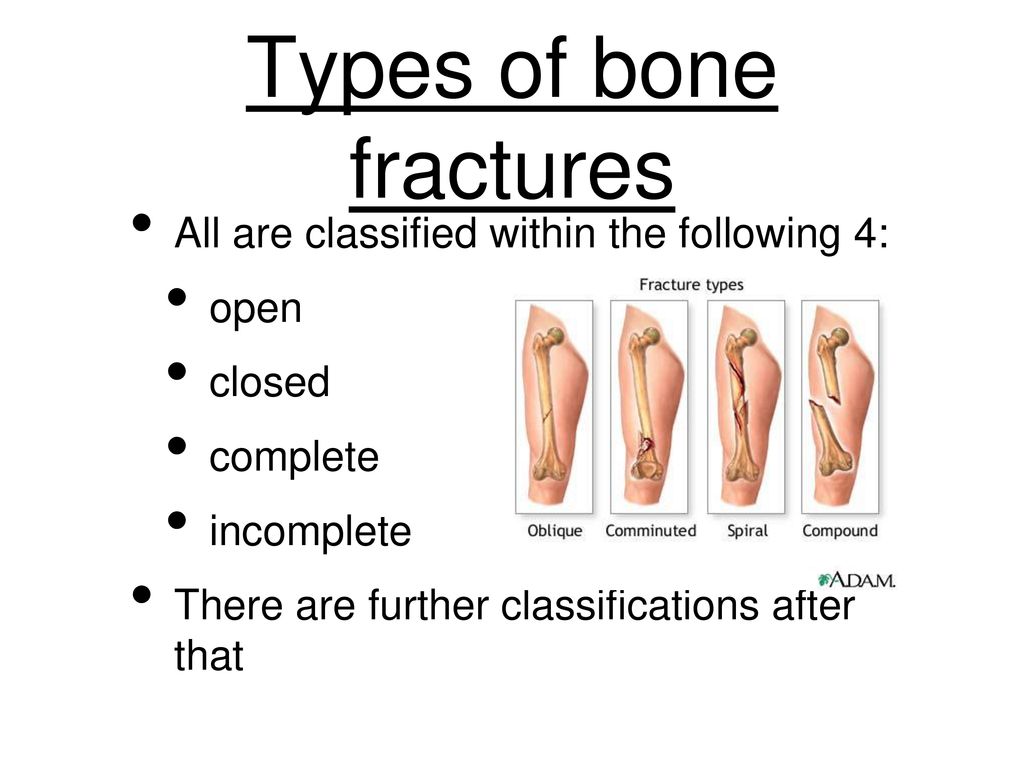 Open vs closed fracture