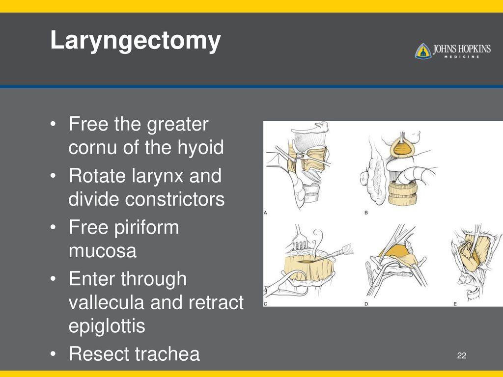Laryngectomy Free the greater cornu of the hyoid