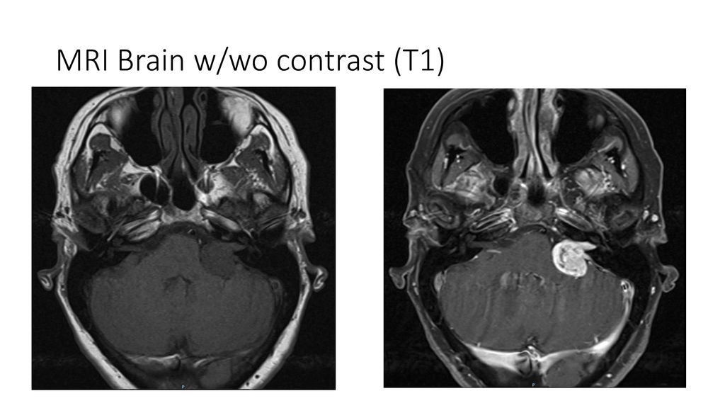 Diagnostic Neuroradiology Case Ppt Download 