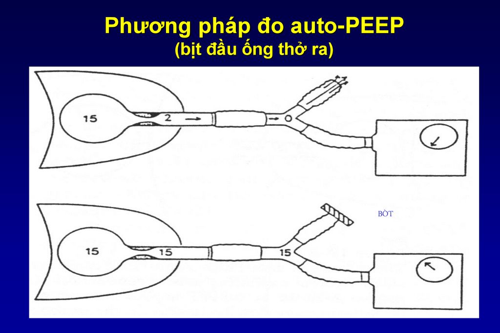Phương pháp đo auto-PEEP (bịt đầu ống thở ra)