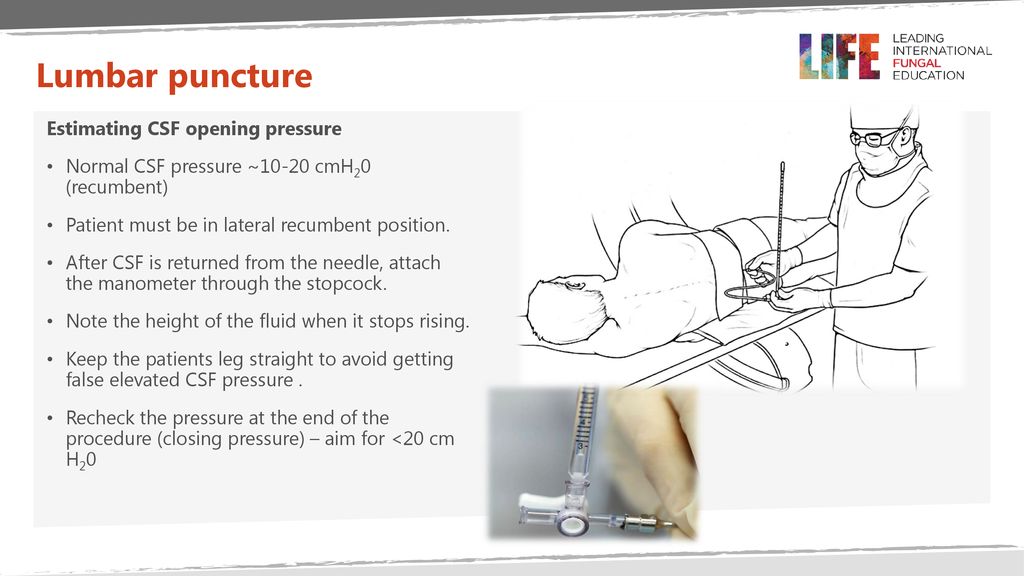 Lumbar puncture Dr. Neil Stone ppt download