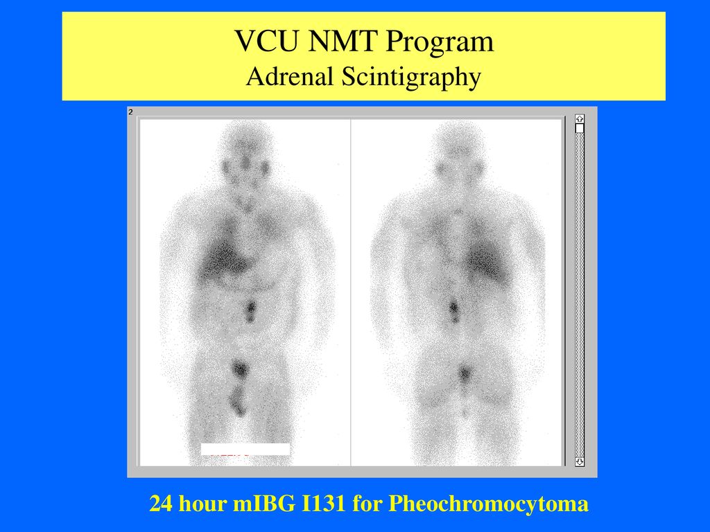 VCU NMT Program Adrenal Scintigraphy