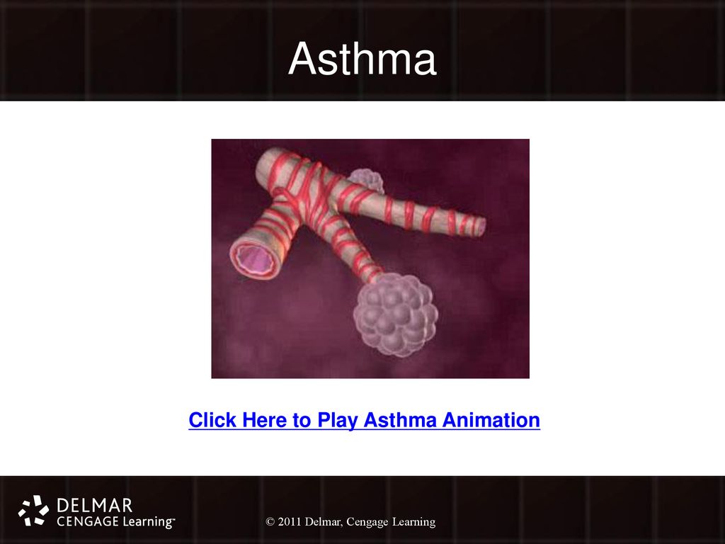 Asthma Click Here to Play Asthma Animation