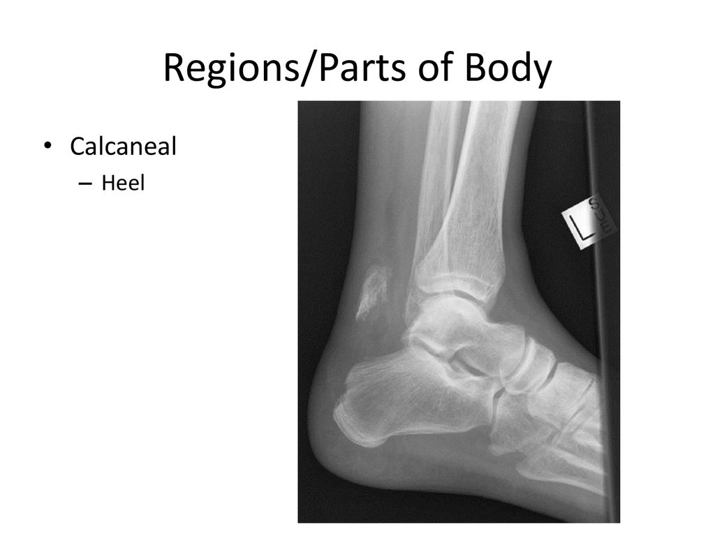 Regions/Parts of Body Calcaneal Heel