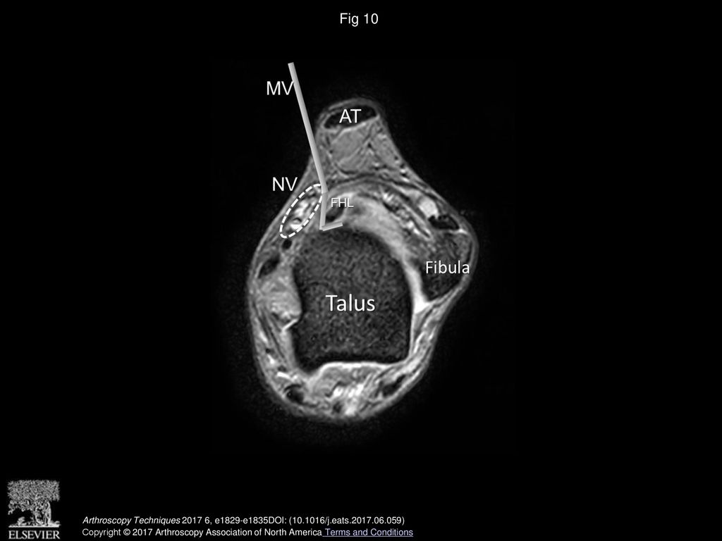 Endoscopic All Inside Repair Of The Flexor Hallucis Longus Tendon In Posterior Ankle Impingement