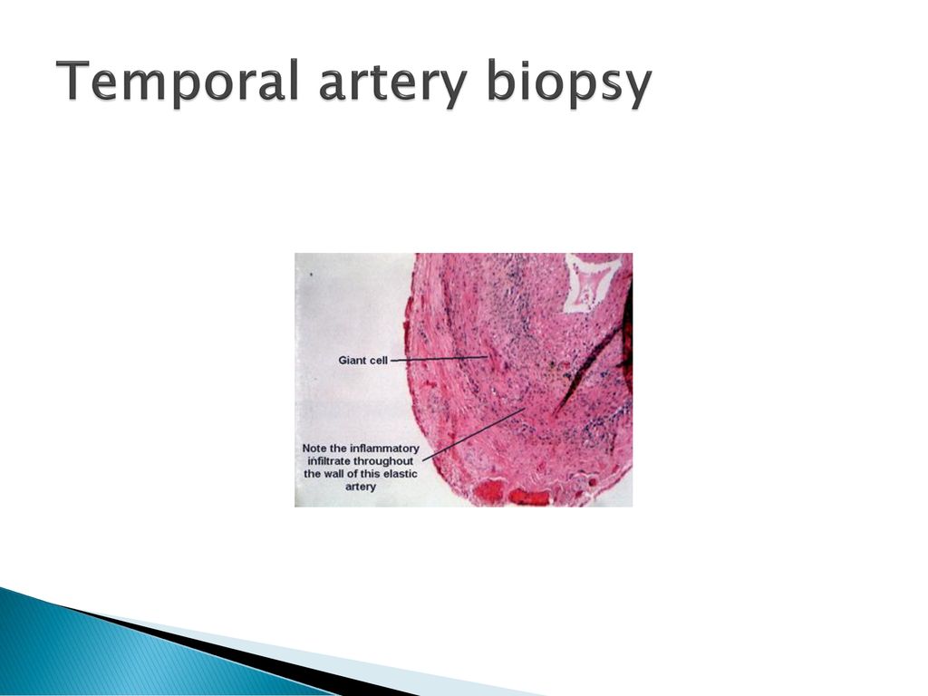 Temporal artery biopsy
