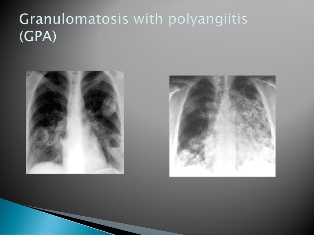 Granulomatosis with polyangiitis (GPA)