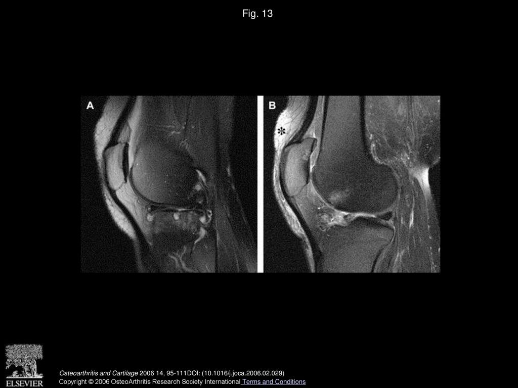 Mri Protocols For Whole Organ Assessment Of The Knee In