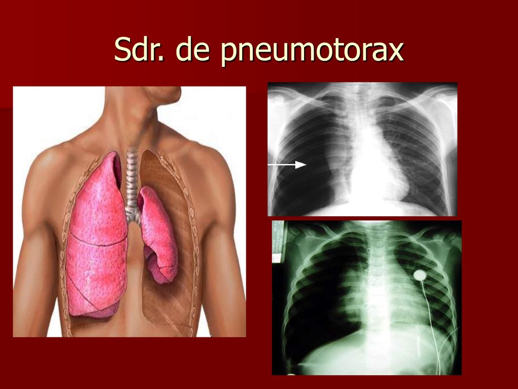 Sdr. respiratorii. - ppt download