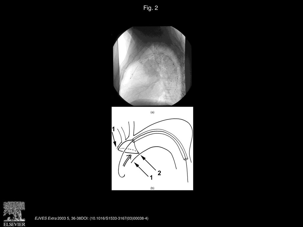 Endovascular Grafting Into The Aortic Arch Ppt Download endovascular-grafting-into-the-aortic-arch-ppt-download