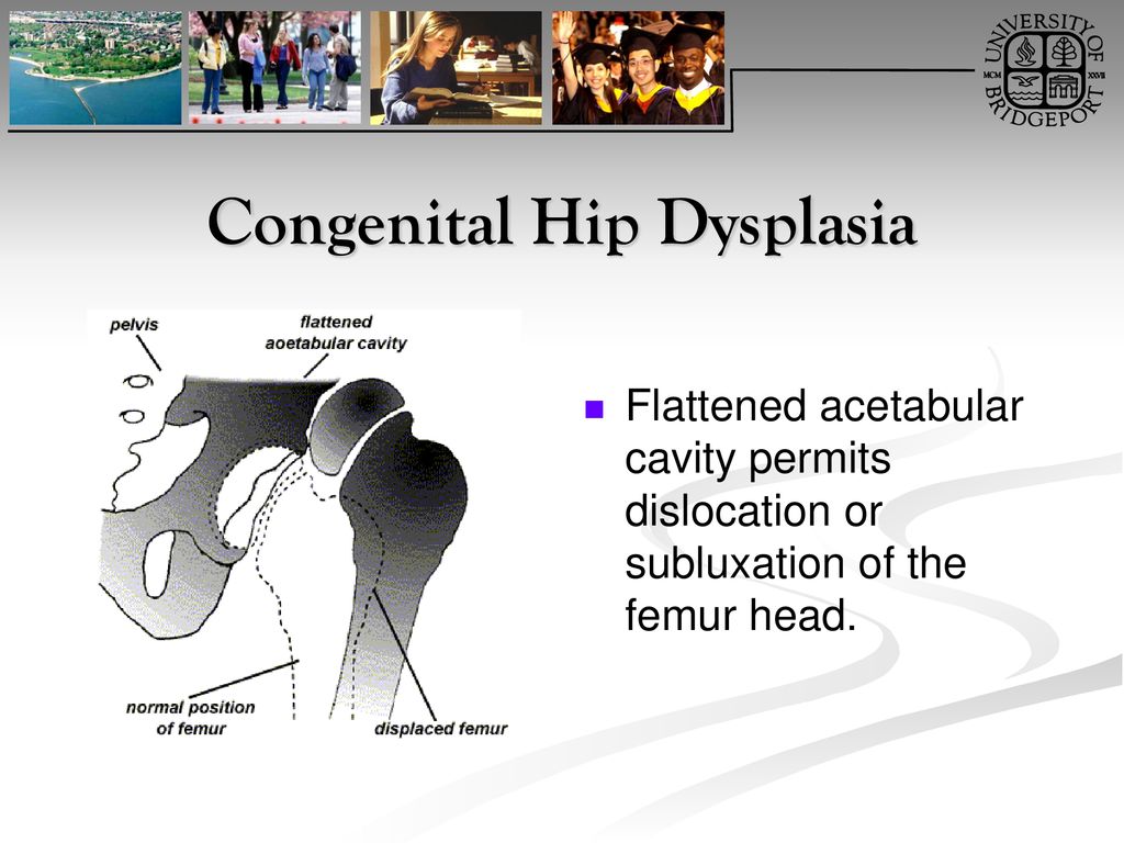 Congenital Hip Dysplasia