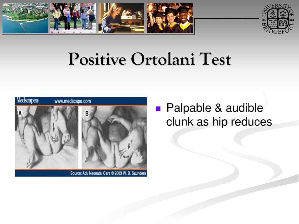 Positive Ortolani Test