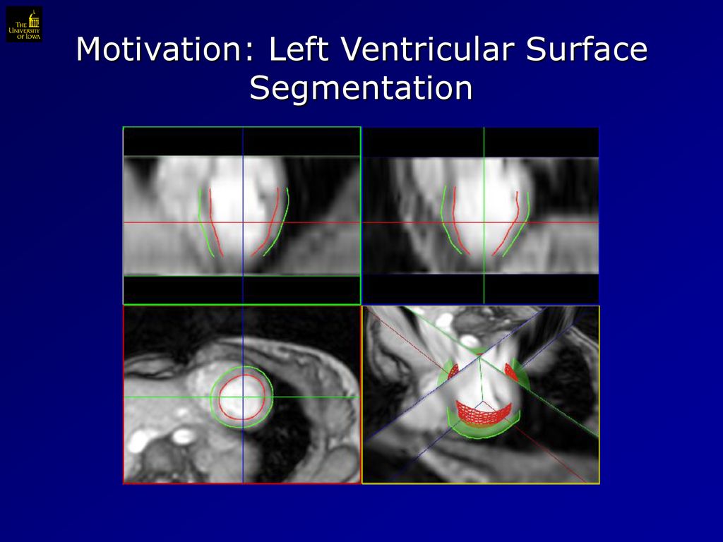 Motivation: Left Ventricular Surface Segmentation
