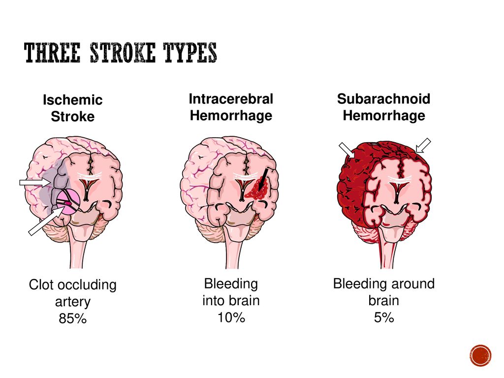 Размер инсульта. Поражения головного мозга при ишемическом инсульта. Геморрагический инсульт по локализации. ОНМК геморрагический инсульт симптомы. Ишемический инсульт общемозговые симптомы.