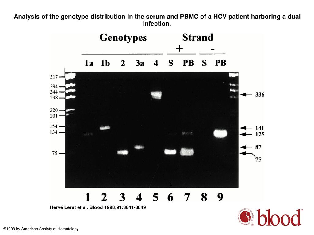 Analysis of the genotype distribution in the serum and PBMC of a HCV patient harboring a dual infection.